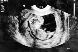 Abtreibungen in den USA nur leicht gesunken